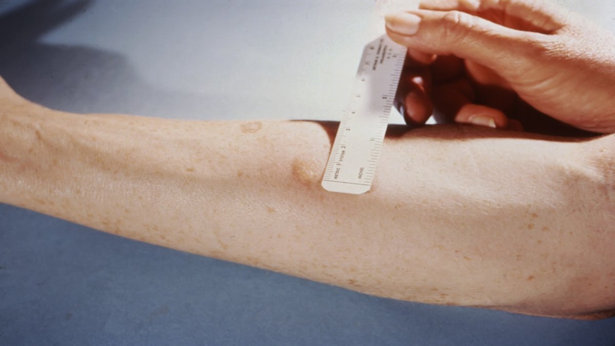 can microneedling cause infection signs to watch
